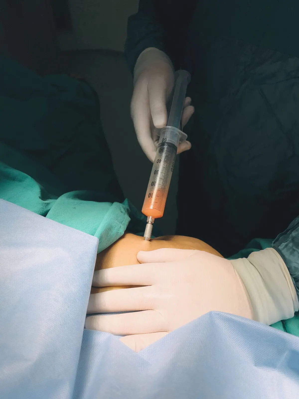 Infiltrazione articolare eseguita con guanti sterili e teli sterili